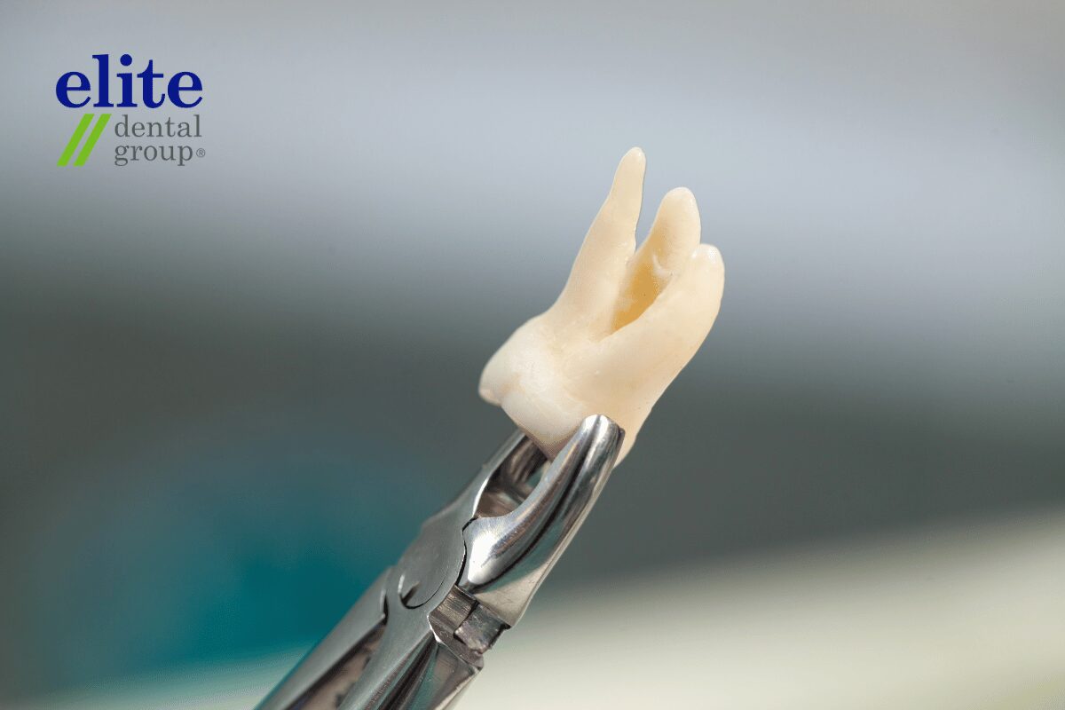 Tooth Extraction | Alternatives to Root Canal Treatment