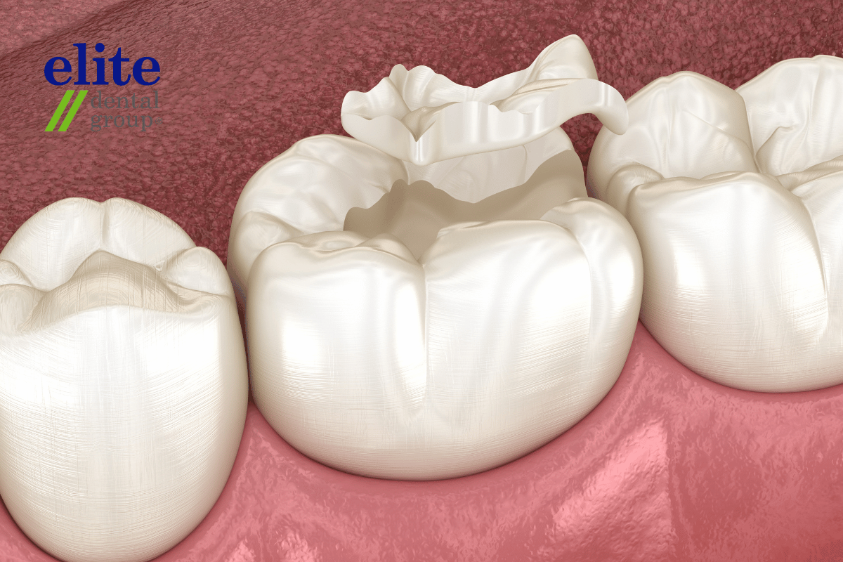 Broken and chipped teeth | Root Canal Treatment Broken and chipped teeth | Root Canal Treatment