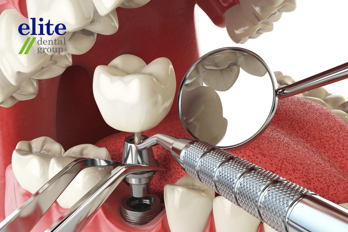 Dental Implants | Elite Dental Group