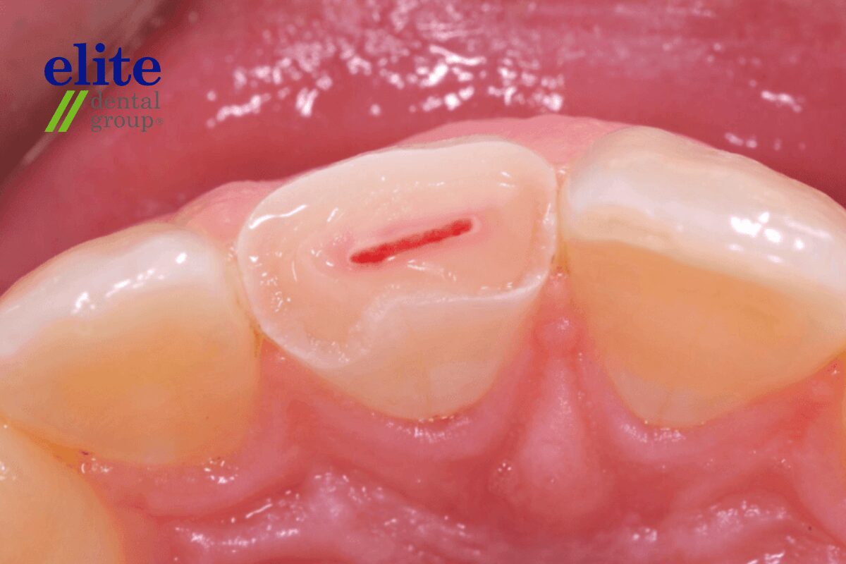 Direct Pulp Capping | Elite Dental Group