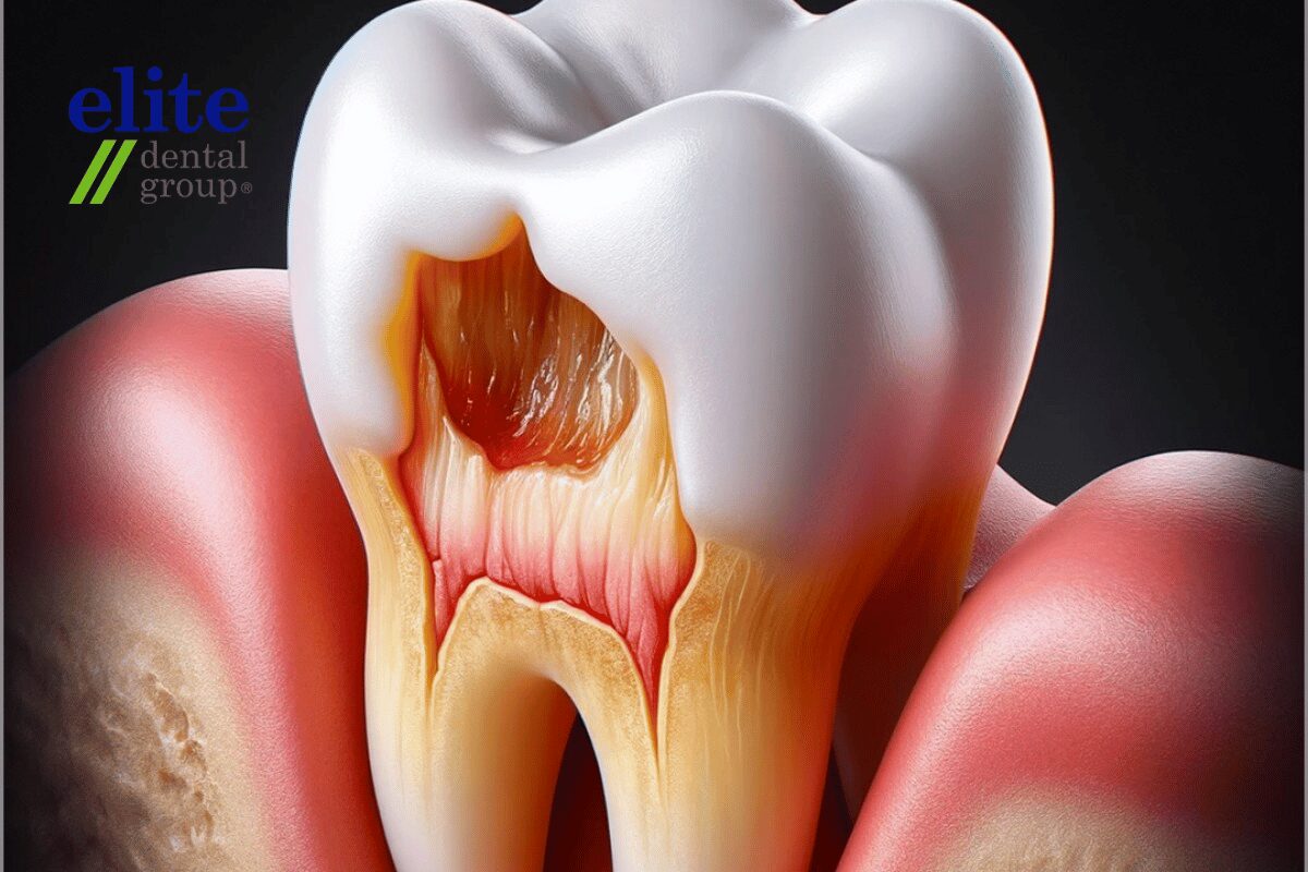 Pulpotomy | Elite Dental Group