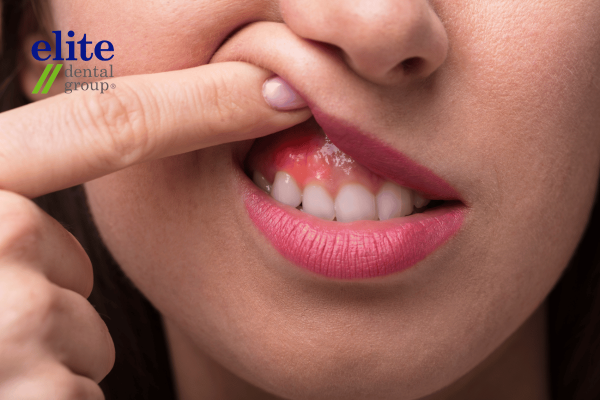 Woman with swollen and red gums | Root Canal Treatment Woman with swollen and red gums | Root Canal Treatment