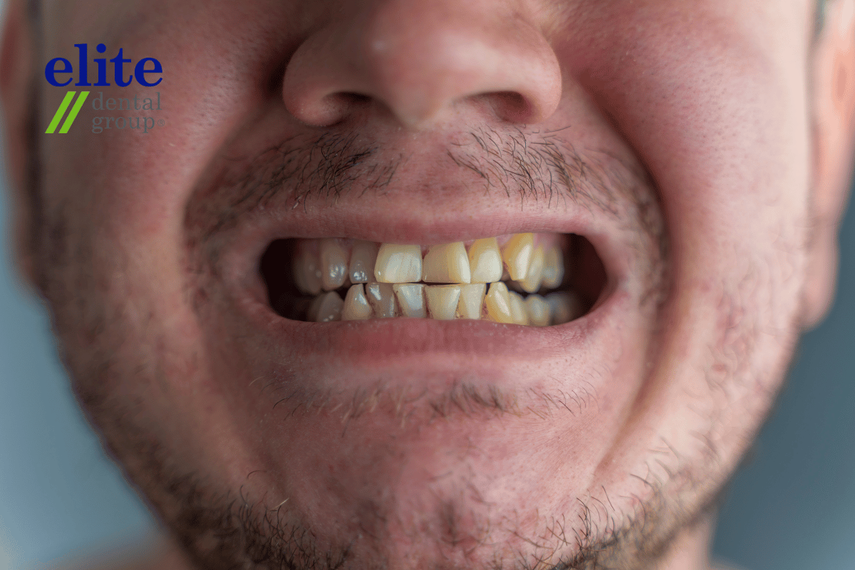Discoloured or darkened teeth | Root Canal Treatment Discoloured or darkened teeth | Root Canal Treatment