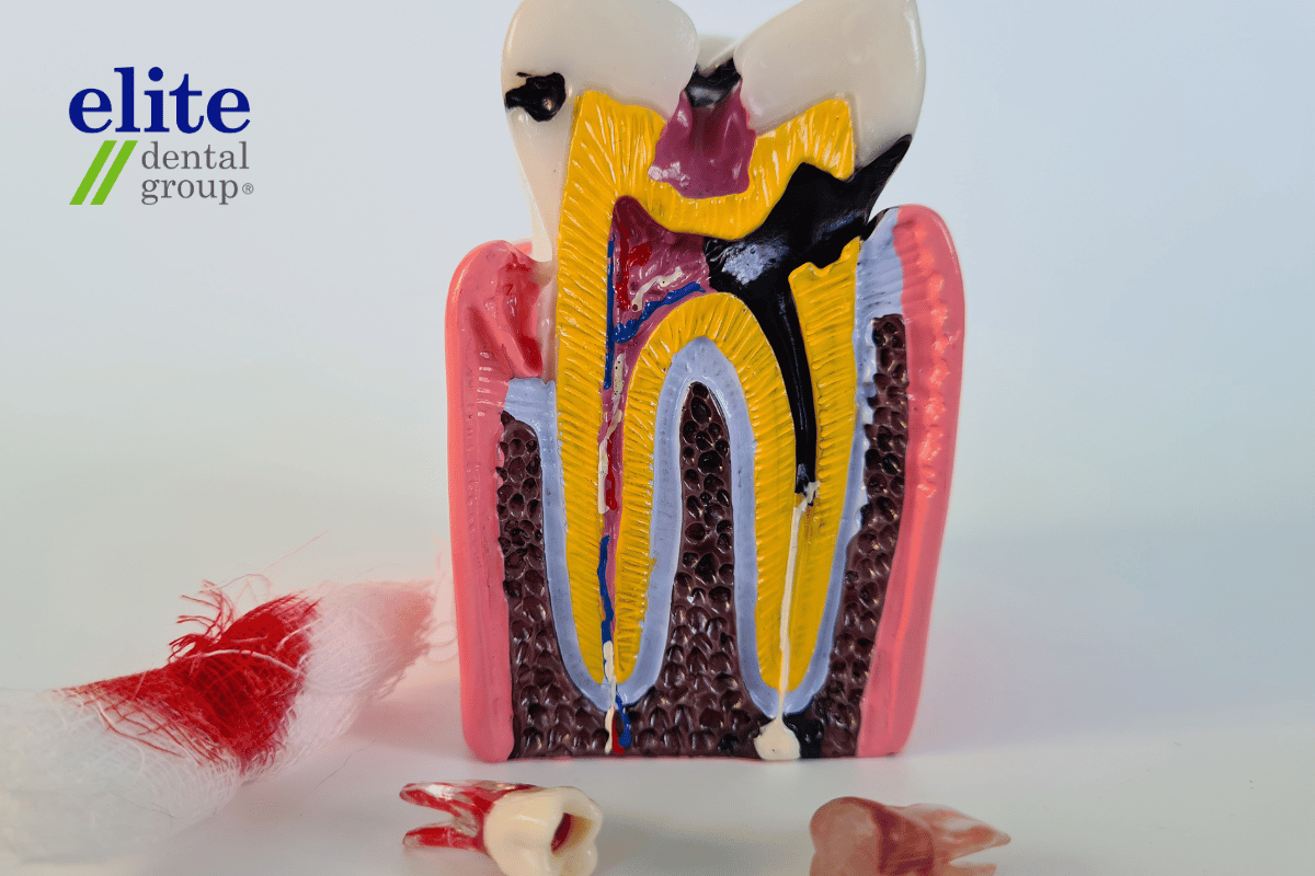 Root Canal Treatment Model | Elite Dental Group Root Canal Treatment Model | Elite Dental Group